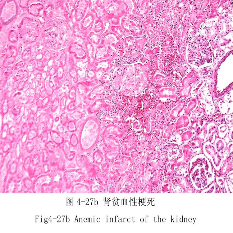 腎貧血性梗死