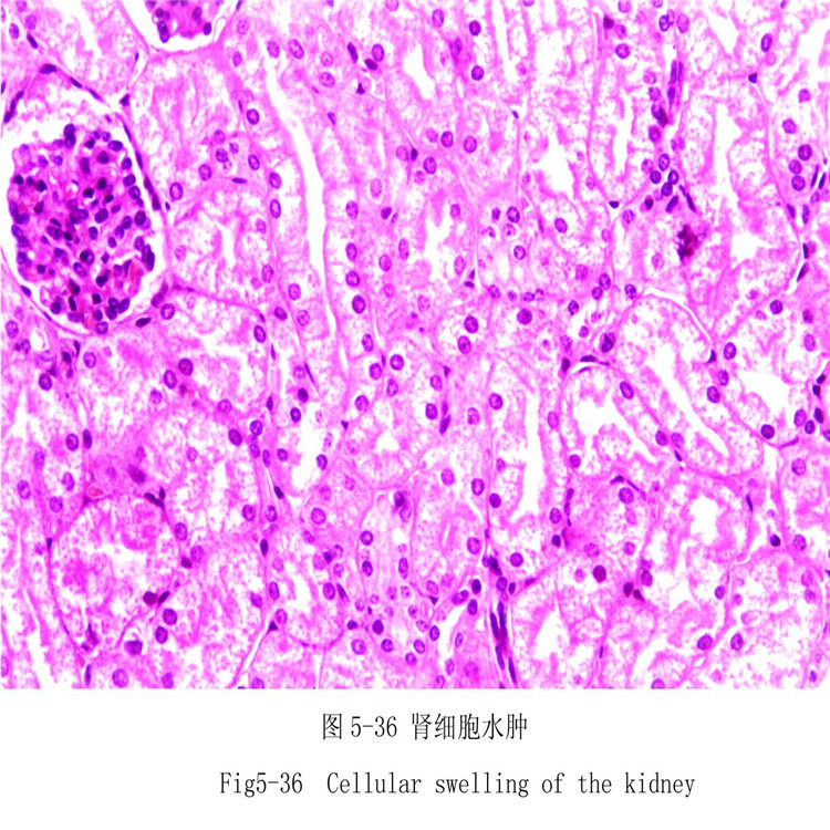 腎細(xì)胞水腫