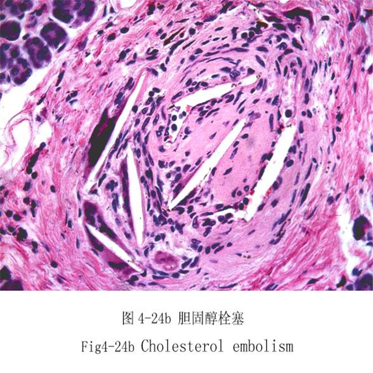 膽固醇栓塞
