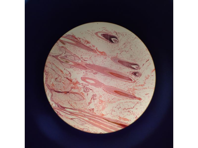 95-頭皮示毛囊切片